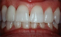 dental implant after