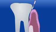 LPT laser periodontal therapy
