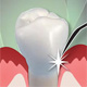 laser periodontal therapy